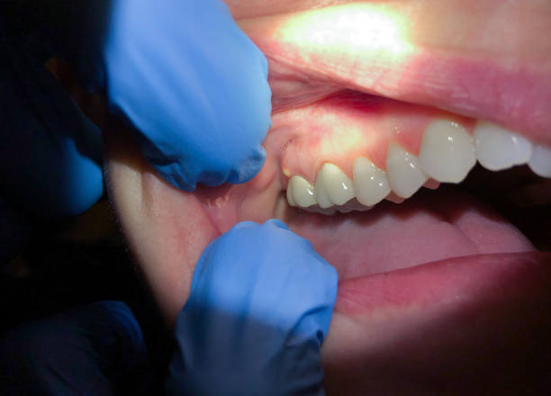 Best Emergency Denture Repair in Belle Plaine, KS